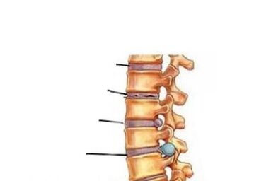 Catro etapas de desenvolvemento da osteocondrose